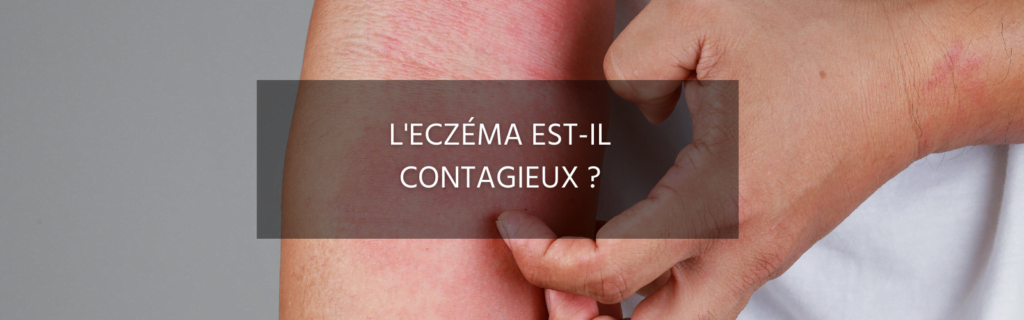 Est-ce que l’eczéma peut se transmettre aux autres ?