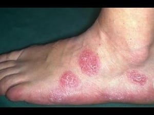 Photo d'eczema nummulaire