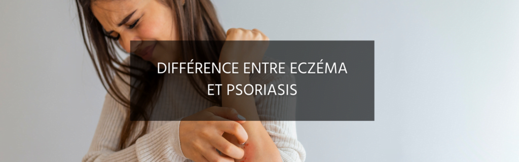 Comment faire la différence entre eczéma et psoriasis ?