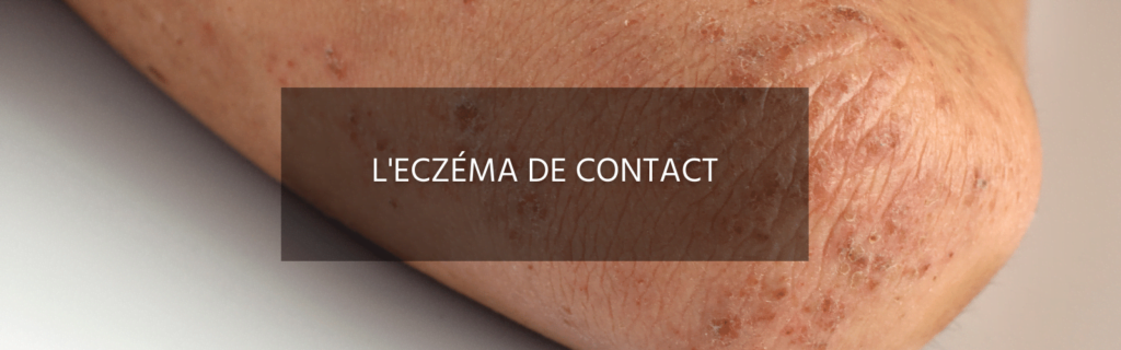 Tout savoir sur l’eczéma de contact