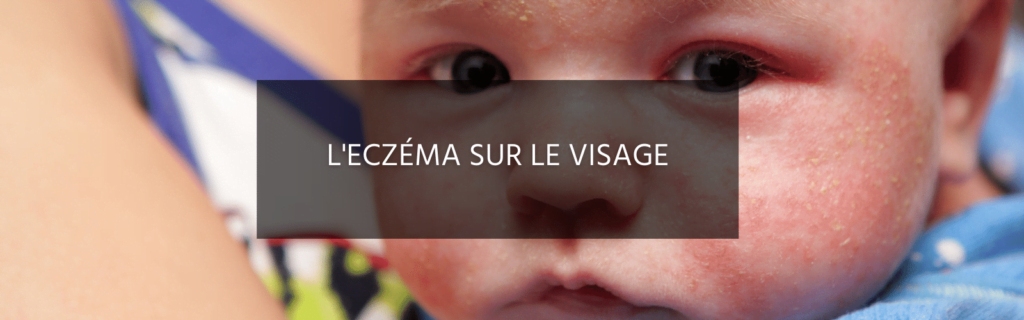 Quelles sont les causes de l’eczéma sur le visage et comment le traiter ?
