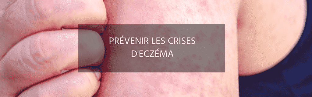 Crise d’eczéma : Comment la prévenir ?