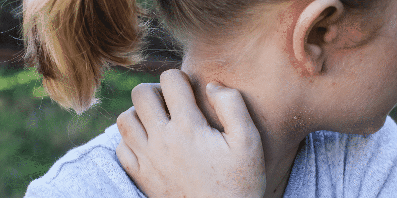eczema oreille