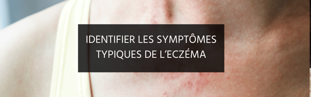 Identifier les symptômes typiques de l’eczéma : un challenge à ne pas sous-estimer