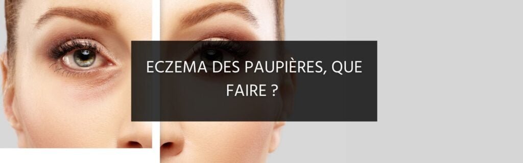 Mes recommandations pour l’eczéma des paupières (+ 5 remèdes)