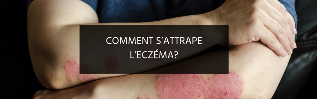 Comment s’attrape l’eczéma ?