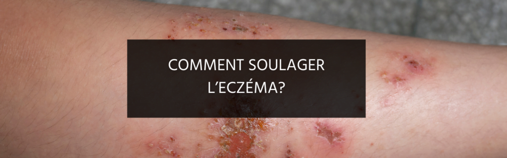 Comment soulager l’eczéma ?