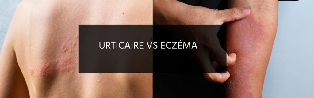 La différence entre l’urticaire et l’eczéma ?