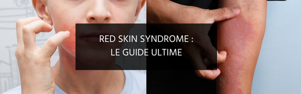 Effet rebond après l’arrêt de la cortisone : tout savoir sur le Red Skin Syndrome