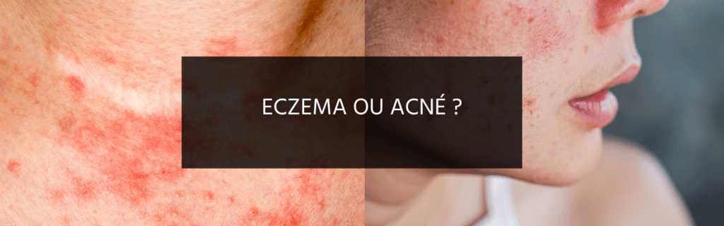 Acné et eczéma : deux problèmes de peau différents, mais des approches naturelles communes